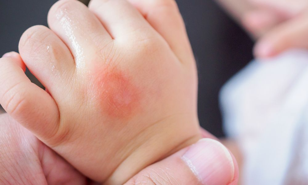 Cách sử dụng vỏ chuối để trị 3 tình trạng ngoài da thường gặp