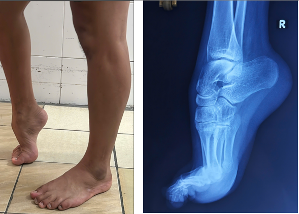 BV Trường ĐH Y Dược Huế phẫu thuật thành công ca bàn chân thuổng bẩm sinh ở người lớn