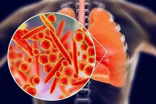 Bộ Y tế khuyến cáo người dân trước thông tin ca tử vong do viêm phổi tại Nga